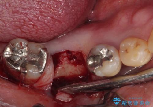 抜歯して放置したままの奥歯 即時荷重インプラントの治療前
