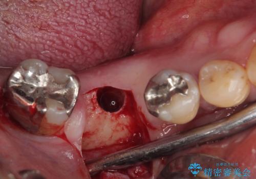 抜歯して放置したままの奥歯 即時荷重インプラントの治療中