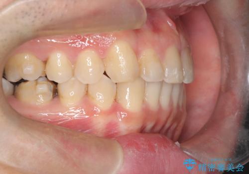 正中離開・クロスバイト・すきっ歯・叢生|インビザラインで治療の治療中