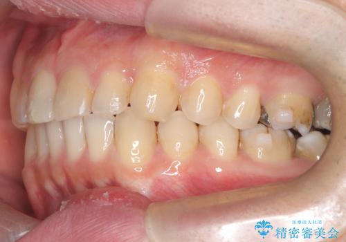 正中離開・クロスバイト・すきっ歯・叢生|インビザラインで治療の治療中