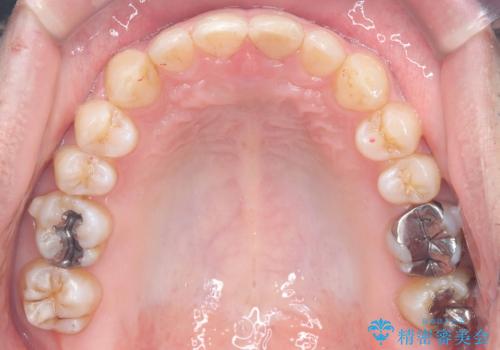 正中離開・クロスバイト・すきっ歯・叢生|インビザラインで治療の治療中