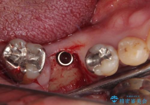 抜歯して放置したままの奥歯 即時荷重インプラントの治療後