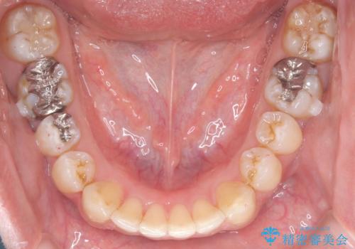 正中離開・クロスバイト・すきっ歯・叢生|インビザラインで治療の治療中