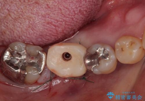 抜歯して放置したままの奥歯 即時荷重インプラントの治療中