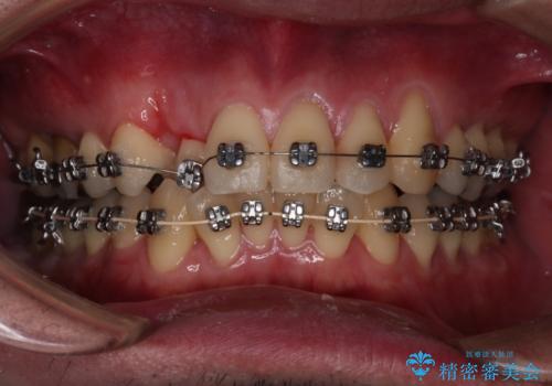 【メタル装置】1本のみ抜歯してワイヤー矯正の治療中