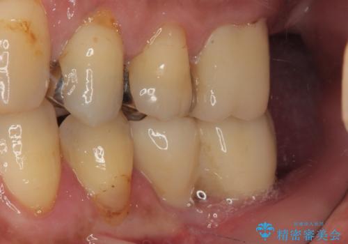 割れて揺れている奥歯　抜歯即時・早期埋入インプラント治療の治療後