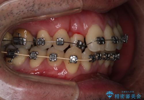 【メタル装置】1本のみ抜歯してワイヤー矯正の治療中