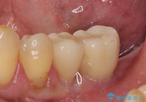 割れて揺れている奥歯　抜歯即時・早期埋入インプラント治療の治療後