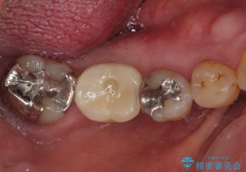 抜歯して放置したままの奥歯　即時荷重インプラントの症例 治療後