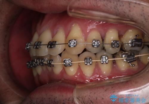 【メタル装置】1本のみ抜歯してワイヤー矯正の治療中