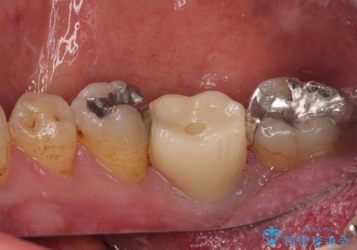 抜歯して放置したままの奥歯　即時荷重インプラントの治療後