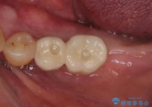 割れて揺れている奥歯 抜歯即時・早期埋入インプラント治療の治療後