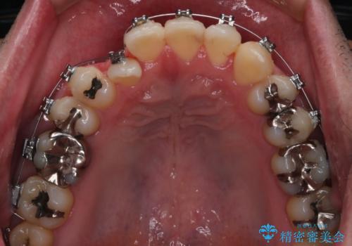【メタル装置】1本のみ抜歯してワイヤー矯正の治療中