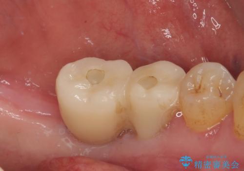 割れて揺れている奥歯 抜歯即時・早期埋入インプラント治療の治療後