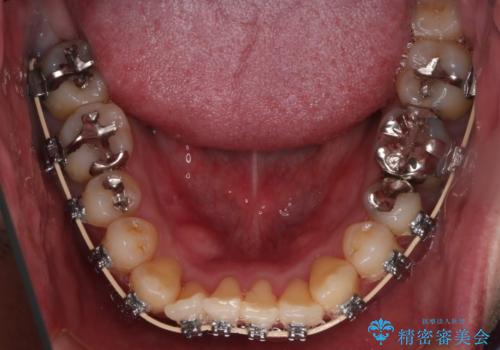 【メタル装置】1本のみ抜歯してワイヤー矯正の治療中