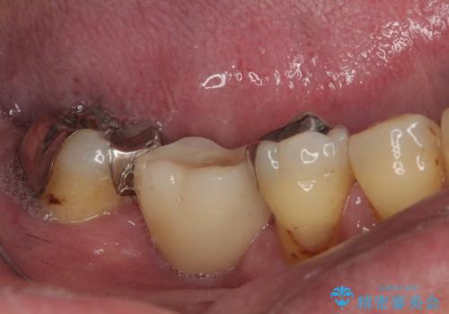 抜歯して放置したままの奥歯　即時荷重インプラントの治療後