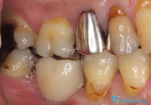 抜歯して放置したままの奥歯 即時荷重インプラントの治療後