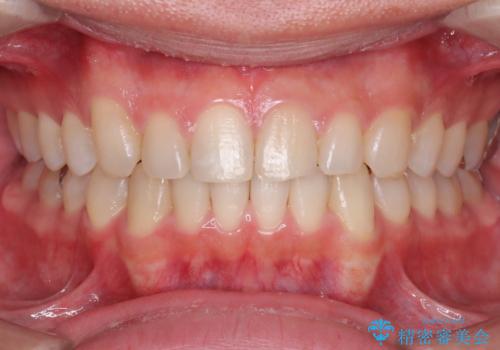 正中離開・クロスバイト・すきっ歯・叢生|インビザラインで治療の症例 治療後