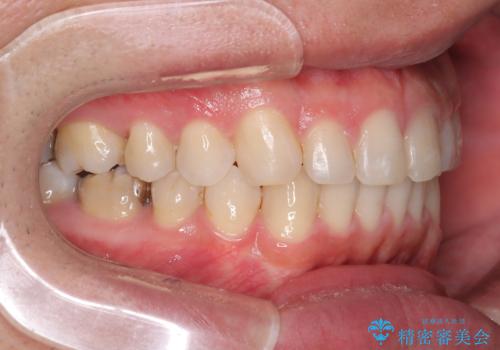 正中離開・クロスバイト・すきっ歯・叢生|インビザラインで治療の治療後