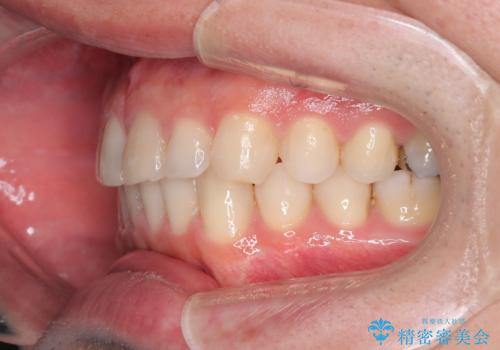 正中離開・クロスバイト・すきっ歯・叢生|インビザラインで治療の治療後