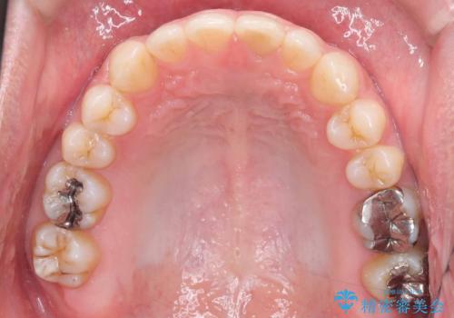 正中離開・クロスバイト・すきっ歯・叢生|インビザラインで治療の治療後