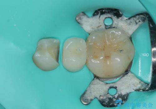 被せものが割れた オールセラミッククラウン・セラミックインレー修復の治療中