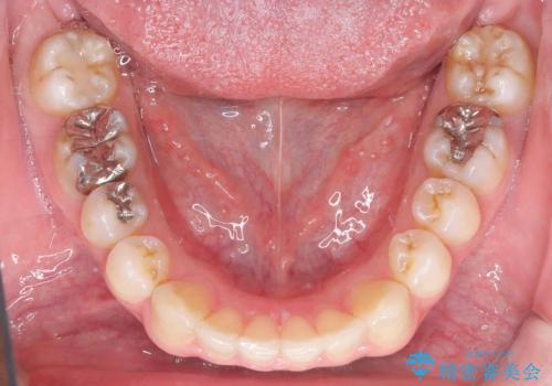 正中離開・クロスバイト・すきっ歯・叢生|インビザラインで治療の治療後