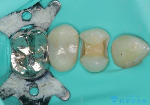 欠けた詰め物を精密セラミックインレーで自然に修復した症例の治療中