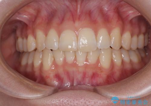 気になる前歯と咬み合わせを改善 インビザライン・モデレートの治療後