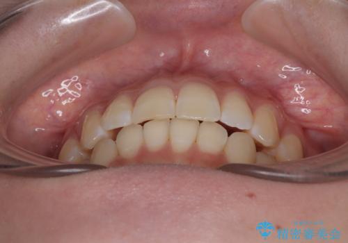 気になる前歯と咬み合わせを改善　インビザライン・モデレートの治療後