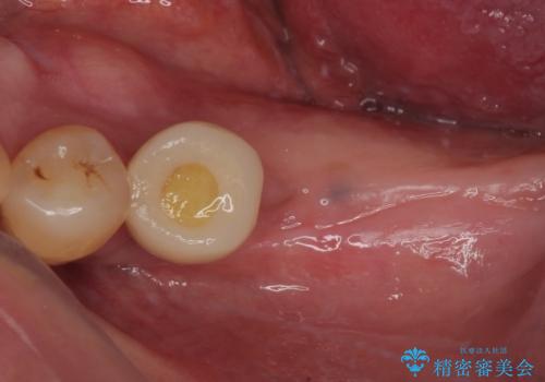 割れて揺れている奥歯　抜歯即時・早期埋入インプラント治療の治療中
