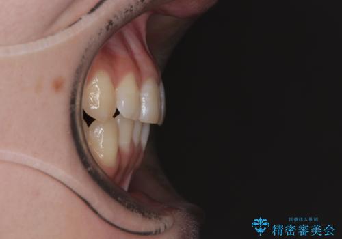 気になる前歯と咬み合わせを改善　インビザライン・モデレートの治療後