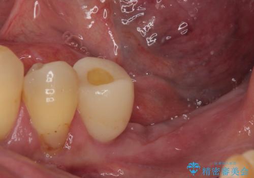 割れて揺れている奥歯 抜歯即時・早期埋入インプラント治療の治療中