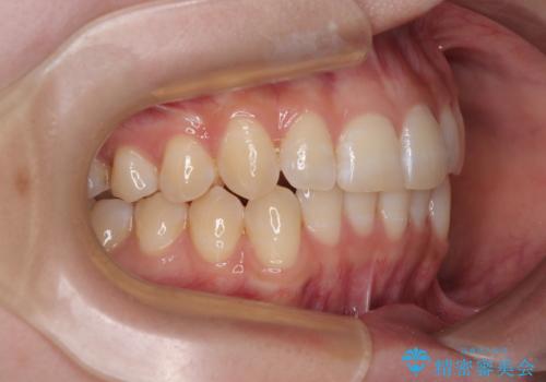 気になる前歯と咬み合わせを改善 インビザライン・モデレートの治療後