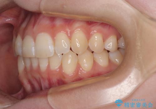 気になる前歯と咬み合わせを改善 インビザライン・モデレートの治療後