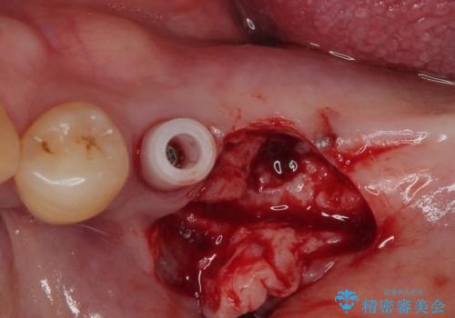 割れて揺れている奥歯　抜歯即時・早期埋入インプラント治療の治療中