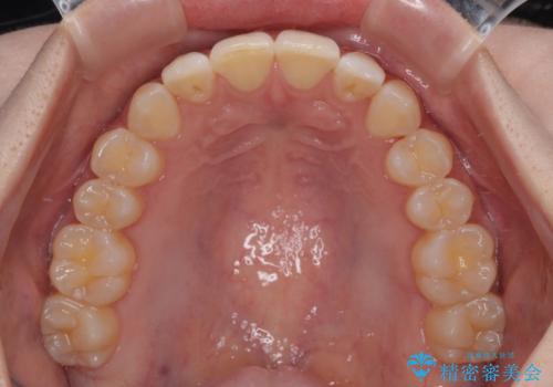 気になる前歯と咬み合わせを改善 インビザライン・モデレートの治療後