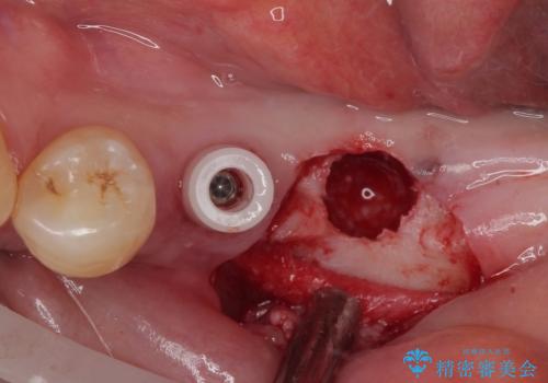 割れて揺れている奥歯 抜歯即時・早期埋入インプラント治療の治療後