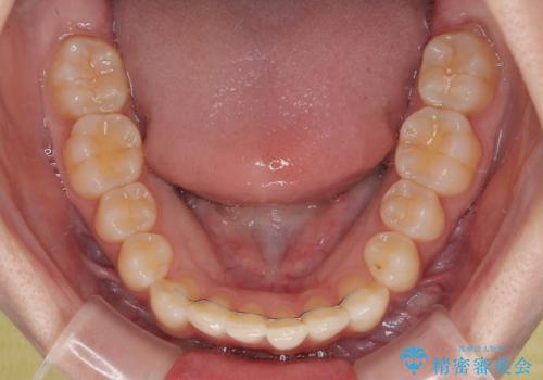 気になる前歯と咬み合わせを改善　インビザライン・モデレートの治療後