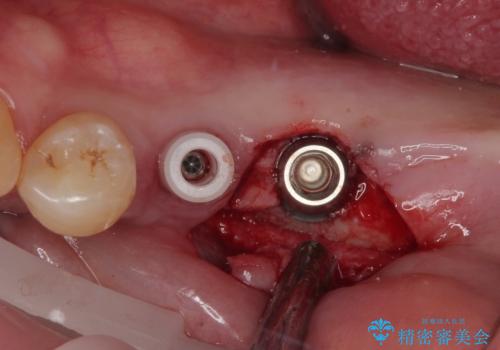 割れて揺れている奥歯 抜歯即時・早期埋入インプラント治療の治療前