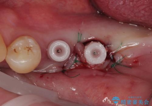 割れて揺れている奥歯　抜歯即時・早期埋入インプラント治療の治療中
