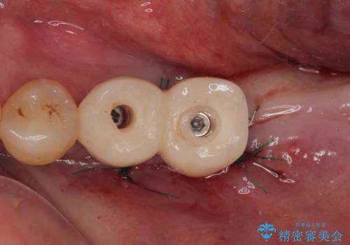 割れて揺れている奥歯 抜歯即時・早期埋入インプラント治療の治療後