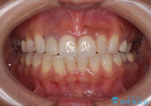 適合不良のラミネートベニアをやり替えて自然な笑顔に|オールセラミッククラウンによる前歯補綴症例の症例 治療後