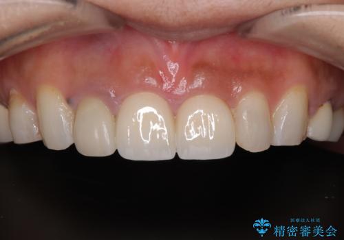 適合不良のラミネートベニアをやり替えて自然な笑顔に|オールセラミッククラウンによる前歯補綴症例の治療後