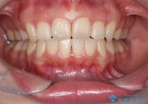 矯正後のホワイトニング希望の症例 治療前