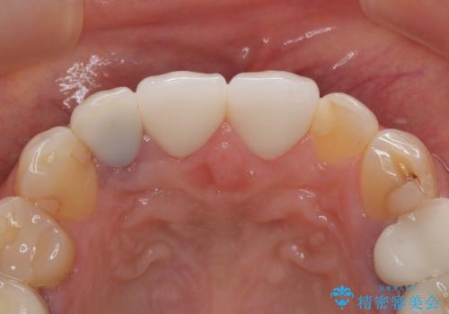 適合不良のラミネートベニアをやり替えて自然な笑顔に|オールセラミッククラウンによる前歯補綴症例の治療後
