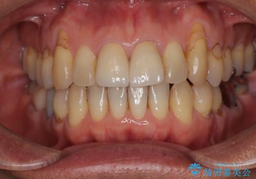 色のバランスの悪い前歯 オールセラミッククラウンで自然な口元にの治療後
