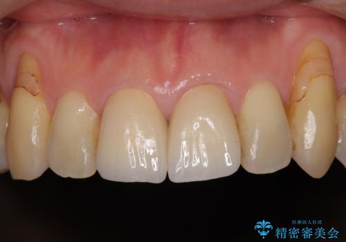 色のバランスの悪い前歯 オールセラミッククラウンで自然な口元にの症例 治療後