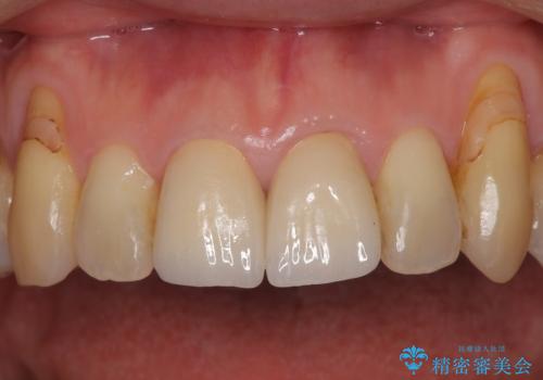 色のバランスの悪い前歯　オールセラミッククラウンで自然な口元にの治療後