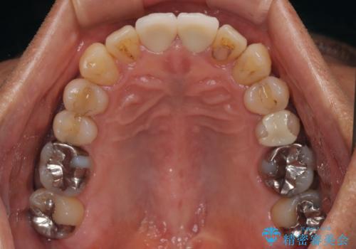 色のバランスの悪い前歯　オールセラミッククラウンで自然な口元にの治療後